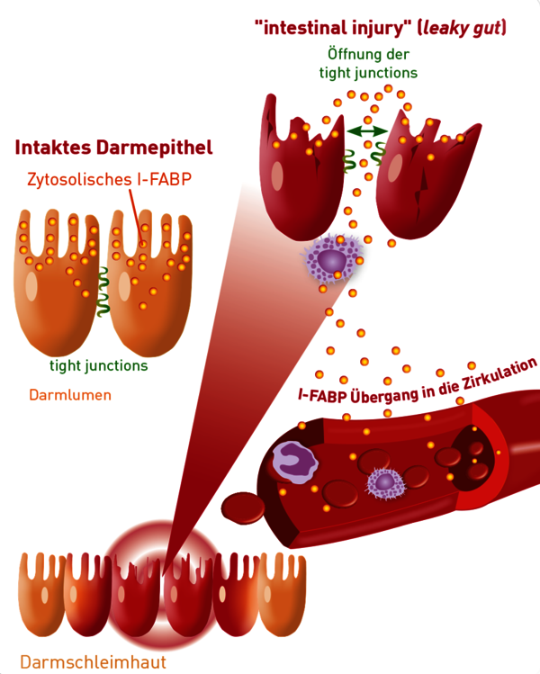 I-FABP Biomarker Leaky gut